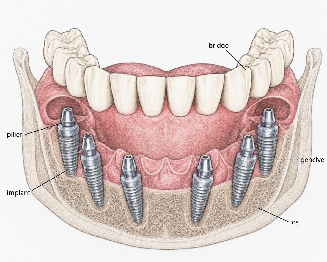 Schéma All-on-6 : bridge complet fixé sur six implants dentaires dans la mandibule — réhabilitation complète à Uzès
