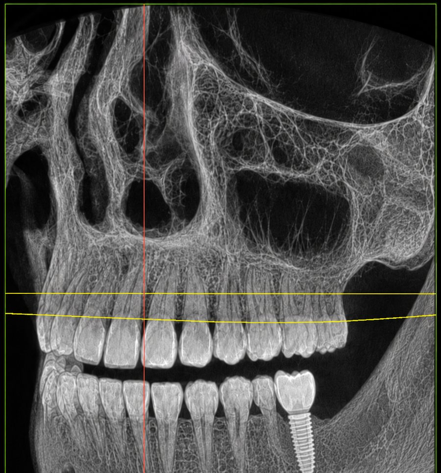 Coupe scanner 3D (cone beam) montrant un implant dentaire pose dans la machoire apres planification guidee a Uzes